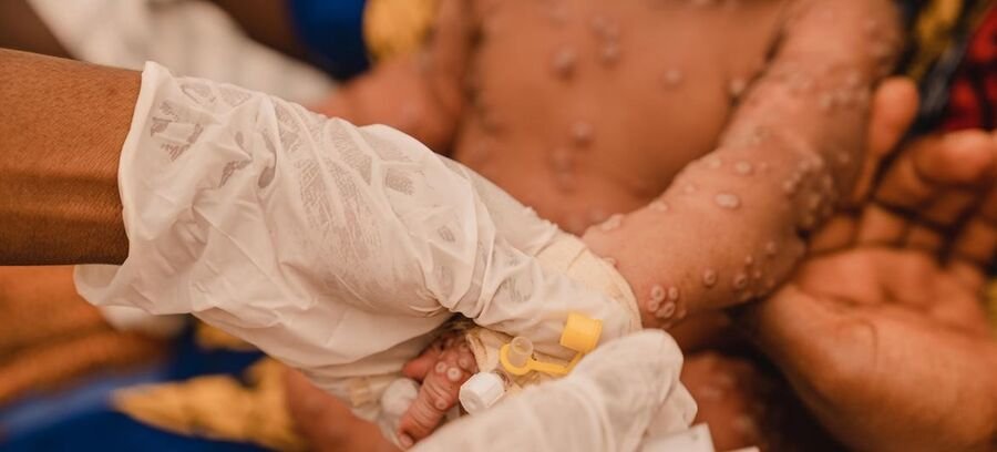 CDC: Less Than 10% Funding Allocated To Africa's Mpox Treatment